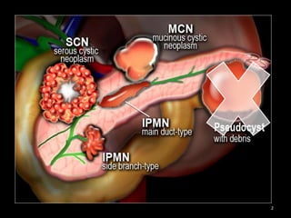 Pancreatic Cysts: A Contemporary Approach | PDF