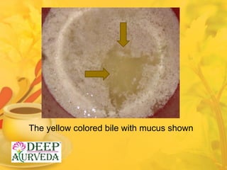The yellow colored bile with mucus shown
 