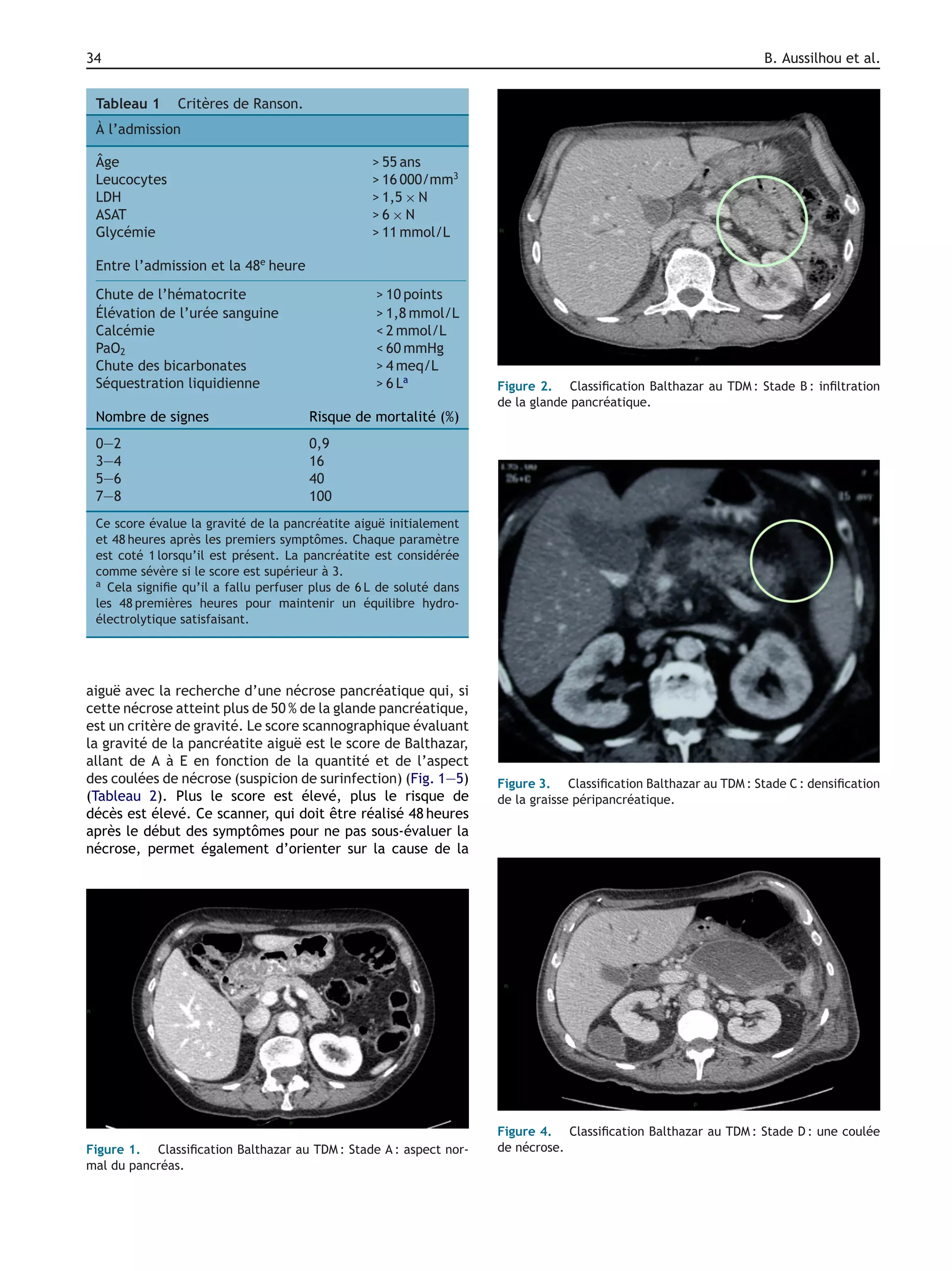 34 B. Aussilhou et al.
Tableau 1 Critères de Ranson.
À l’admission
Âge > 55 ans
Leucocytes > 16 000/mm3
LDH > 1,5 × N
ASAT > 6 × N
Glycémie > 11 mmol/L
Entre l’admission et la 48e
heure
Chute de l’hématocrite > 10 points
Élévation de l’urée sanguine > 1,8 mmol/L
Calcémie < 2 mmol/L
PaO2 < 60 mmHg
Chute des bicarbonates > 4 meq/L
Séquestration liquidienne > 6 La
Nombre de signes Risque de mortalité (%)
0—2 0,9
3—4 16
5—6 40
7—8 100
Ce score évalue la gravité de la pancréatite aiguë initialement
et 48 heures après les premiers symptômes. Chaque paramètre
est coté 1 lorsqu’il est présent. La pancréatite est considérée
comme sévère si le score est supérieur à 3.
a Cela signiﬁe qu’il a fallu perfuser plus de 6 L de soluté dans
les 48 premières heures pour maintenir un équilibre hydro-
électrolytique satisfaisant.
aiguë avec la recherche d’une nécrose pancréatique qui, si
cette nécrose atteint plus de 50 % de la glande pancréatique,
est un critère de gravité. Le score scannographique évaluant
la gravité de la pancréatite aiguë est le score de Balthazar,
allant de A à E en fonction de la quantité et de l’aspect
des coulées de nécrose (suspicion de surinfection) (Fig. 1—5)
(Tableau 2). Plus le score est élevé, plus le risque de
décès est élevé. Ce scanner, qui doit être réalisé 48 heures
après le début des symptômes pour ne pas sous-évaluer la
nécrose, permet également d’orienter sur la cause de la
Figure 1. Classiﬁcation Balthazar au TDM : Stade A : aspect nor-
mal du pancréas.
Figure 2. Classiﬁcation Balthazar au TDM : Stade B : inﬁltration
de la glande pancréatique.
Figure 3. Classiﬁcation Balthazar au TDM : Stade C : densiﬁcation
de la graisse péripancréatique.
Figure 4. Classiﬁcation Balthazar au TDM : Stade D : une coulée
de nécrose.
 