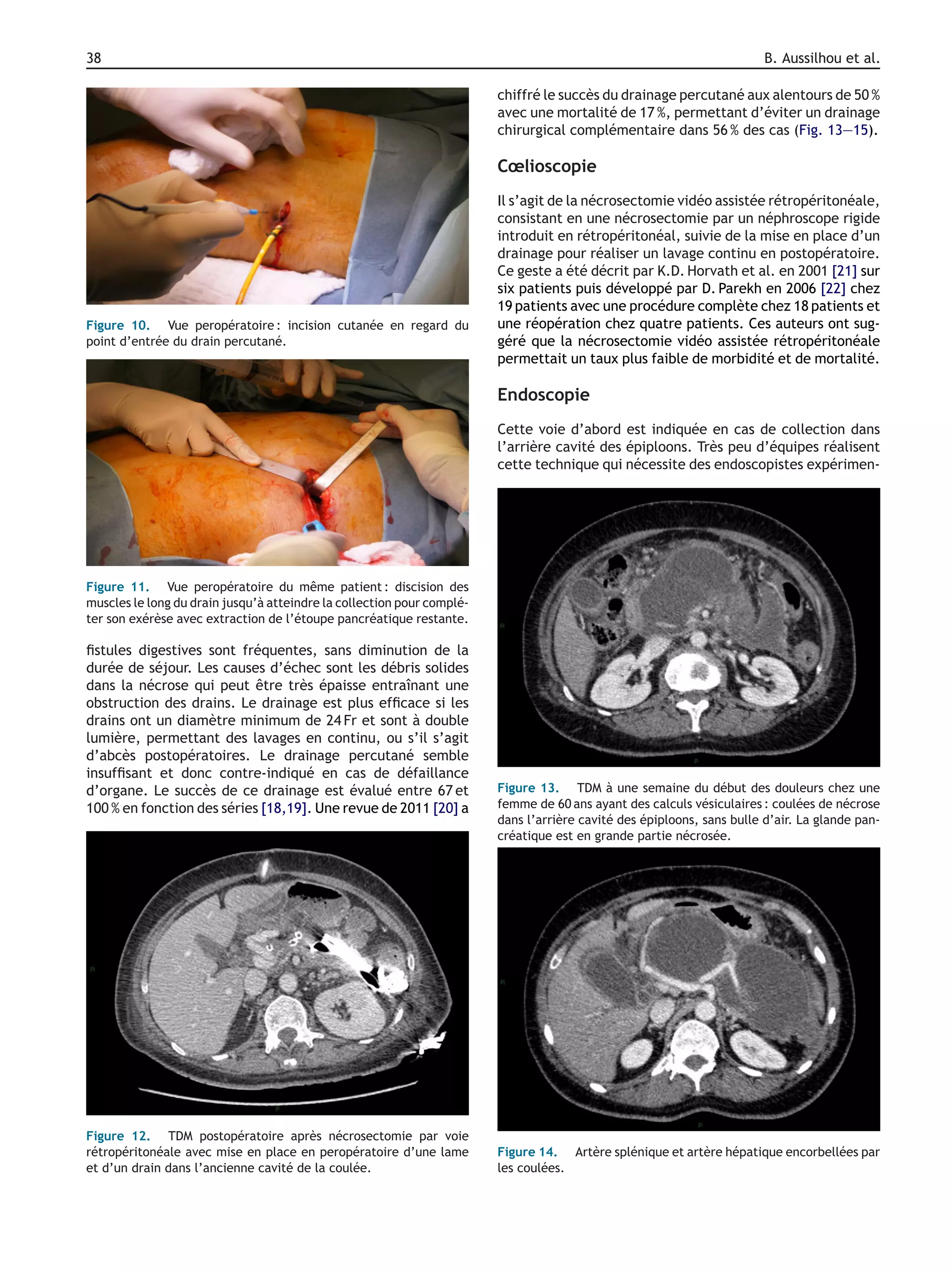 38 B. Aussilhou et al.
Figure 10. Vue peropératoire : incision cutanée en regard du
point d’entrée du drain percutané.
Figure 11. Vue peropératoire du même patient : discision des
muscles le long du drain jusqu’à atteindre la collection pour complé-
ter son exérèse avec extraction de l’étoupe pancréatique restante.
ﬁstules digestives sont fréquentes, sans diminution de la
durée de séjour. Les causes d’échec sont les débris solides
dans la nécrose qui peut être très épaisse entraînant une
obstruction des drains. Le drainage est plus efﬁcace si les
drains ont un diamètre minimum de 24 Fr et sont à double
lumière, permettant des lavages en continu, ou s’il s’agit
d’abcès postopératoires. Le drainage percutané semble
insufﬁsant et donc contre-indiqué en cas de défaillance
d’organe. Le succès de ce drainage est évalué entre 67 et
100 % en fonction des séries [18,19]. Une revue de 2011 [20] a
Figure 12. TDM postopératoire après nécrosectomie par voie
rétropéritonéale avec mise en place en peropératoire d’une lame
et d’un drain dans l’ancienne cavité de la coulée.
chiffré le succès du drainage percutané aux alentours de 50 %
avec une mortalité de 17 %, permettant d’éviter un drainage
chirurgical complémentaire dans 56 % des cas (Fig. 13—15).
Cœlioscopie
Il s’agit de la nécrosectomie vidéo assistée rétropéritonéale,
consistant en une nécrosectomie par un néphroscope rigide
introduit en rétropéritonéal, suivie de la mise en place d’un
drainage pour réaliser un lavage continu en postopératoire.
Ce geste a été décrit par K.D. Horvath et al. en 2001 [21] sur
six patients puis développé par D. Parekh en 2006 [22] chez
19 patients avec une procédure complète chez 18 patients et
une réopération chez quatre patients. Ces auteurs ont sug-
géré que la nécrosectomie vidéo assistée rétropéritonéale
permettait un taux plus faible de morbidité et de mortalité.
Endoscopie
Cette voie d’abord est indiquée en cas de collection dans
l’arrière cavité des épiploons. Très peu d’équipes réalisent
cette technique qui nécessite des endoscopistes expérimen-
Figure 13. TDM à une semaine du début des douleurs chez une
femme de 60 ans ayant des calculs vésiculaires : coulées de nécrose
dans l’arrière cavité des épiploons, sans bulle d’air. La glande pan-
créatique est en grande partie nécrosée.
Figure 14. Artère splénique et artère hépatique encorbellées par
les coulées.
 