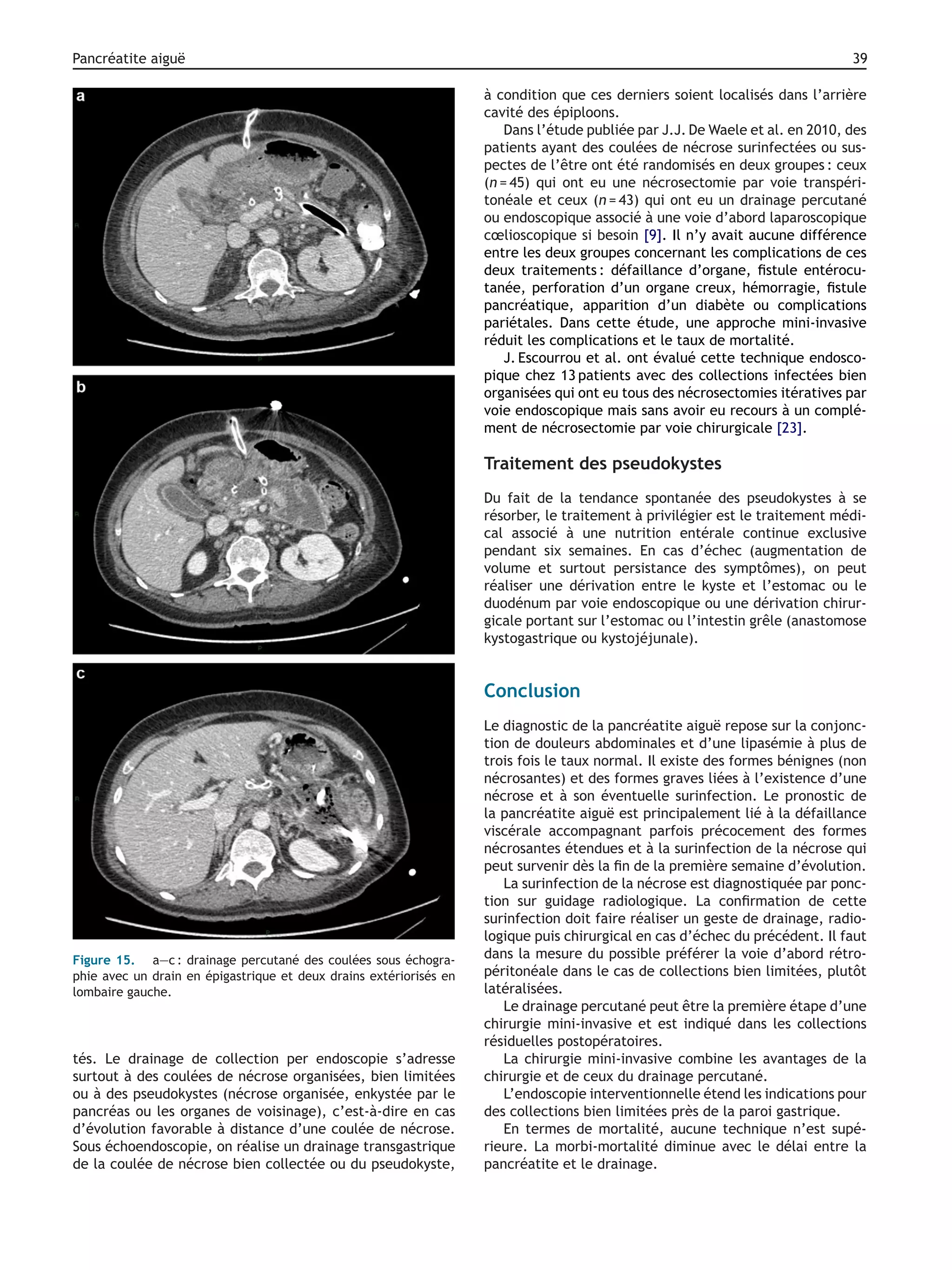 Pancréatite aiguë 39
Figure 15. a—c : drainage percutané des coulées sous échogra-
phie avec un drain en épigastrique et deux drains extériorisés en
lombaire gauche.
tés. Le drainage de collection per endoscopie s’adresse
surtout à des coulées de nécrose organisées, bien limitées
ou à des pseudokystes (nécrose organisée, enkystée par le
pancréas ou les organes de voisinage), c’est-à-dire en cas
d’évolution favorable à distance d’une coulée de nécrose.
Sous échoendoscopie, on réalise un drainage transgastrique
de la coulée de nécrose bien collectée ou du pseudokyste,
à condition que ces derniers soient localisés dans l’arrière
cavité des épiploons.
Dans l’étude publiée par J.J. De Waele et al. en 2010, des
patients ayant des coulées de nécrose surinfectées ou sus-
pectes de l’être ont été randomisés en deux groupes : ceux
(n = 45) qui ont eu une nécrosectomie par voie transpéri-
tonéale et ceux (n = 43) qui ont eu un drainage percutané
ou endoscopique associé à une voie d’abord laparoscopique
cœlioscopique si besoin [9]. Il n’y avait aucune différence
entre les deux groupes concernant les complications de ces
deux traitements : défaillance d’organe, ﬁstule entérocu-
tanée, perforation d’un organe creux, hémorragie, ﬁstule
pancréatique, apparition d’un diabète ou complications
pariétales. Dans cette étude, une approche mini-invasive
réduit les complications et le taux de mortalité.
J. Escourrou et al. ont évalué cette technique endosco-
pique chez 13 patients avec des collections infectées bien
organisées qui ont eu tous des nécrosectomies itératives par
voie endoscopique mais sans avoir eu recours à un complé-
ment de nécrosectomie par voie chirurgicale [23].
Traitement des pseudokystes
Du fait de la tendance spontanée des pseudokystes à se
résorber, le traitement à privilégier est le traitement médi-
cal associé à une nutrition entérale continue exclusive
pendant six semaines. En cas d’échec (augmentation de
volume et surtout persistance des symptômes), on peut
réaliser une dérivation entre le kyste et l’estomac ou le
duodénum par voie endoscopique ou une dérivation chirur-
gicale portant sur l’estomac ou l’intestin grêle (anastomose
kystogastrique ou kystojéjunale).
Conclusion
Le diagnostic de la pancréatite aiguë repose sur la conjonc-
tion de douleurs abdominales et d’une lipasémie à plus de
trois fois le taux normal. Il existe des formes bénignes (non
nécrosantes) et des formes graves liées à l’existence d’une
nécrose et à son éventuelle surinfection. Le pronostic de
la pancréatite aiguë est principalement lié à la défaillance
viscérale accompagnant parfois précocement des formes
nécrosantes étendues et à la surinfection de la nécrose qui
peut survenir dès la ﬁn de la première semaine d’évolution.
La surinfection de la nécrose est diagnostiquée par ponc-
tion sur guidage radiologique. La conﬁrmation de cette
surinfection doit faire réaliser un geste de drainage, radio-
logique puis chirurgical en cas d’échec du précédent. Il faut
dans la mesure du possible préférer la voie d’abord rétro-
péritonéale dans le cas de collections bien limitées, plutôt
latéralisées.
Le drainage percutané peut être la première étape d’une
chirurgie mini-invasive et est indiqué dans les collections
résiduelles postopératoires.
La chirurgie mini-invasive combine les avantages de la
chirurgie et de ceux du drainage percutané.
L’endoscopie interventionnelle étend les indications pour
des collections bien limitées près de la paroi gastrique.
En termes de mortalité, aucune technique n’est supé-
rieure. La morbi-mortalité diminue avec le délai entre la
pancréatite et le drainage.
 