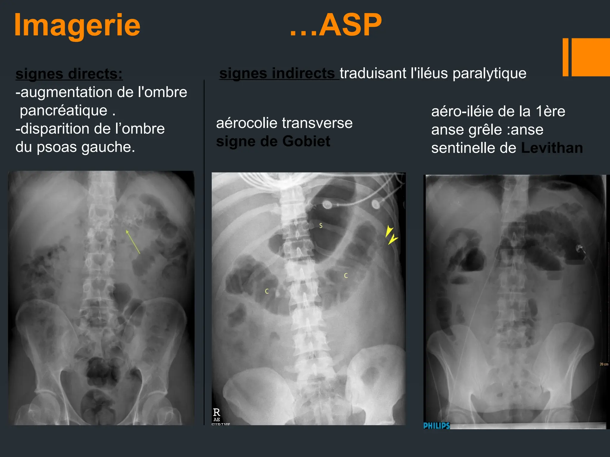 Imagerie …ASP
signes directs:
-augmentation de l'ombre
pancréatique .
-disparition de l’ombre
du psoas gauche.
aérocolie transverse
signe de Gobiet
aéro-iléie de la 1ère
anse grêle :anse
sentinelle de Levithan
signes indirects traduisant l'iléus paralytique
 