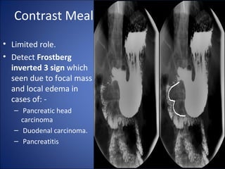 Contrast Meal
• Limited role.
• Detect Frostberg
inverted 3 sign which
seen due to focal mass
and local edema in
cases of: -
– Pancreatic head
carcinoma
– Duodenal carcinoma.
– Pancreatitis
 