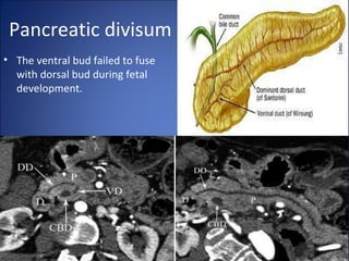 Pancreatic divisum
• The ventral bud failed to fuse
with dorsal bud during fetal
development.
 