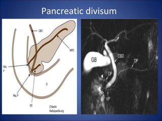 Pancreatic divisum
 