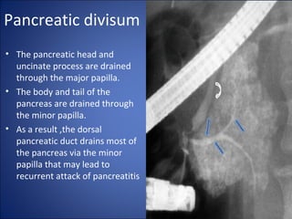 Pancreatic divisum
• The pancreatic head and
uncinate process are drained
through the major papilla.
• The body and tail of the
pancreas are drained through
the minor papilla.
• As a result ,the dorsal
pancreatic duct drains most of
the pancreas via the minor
papilla that may lead to
recurrent attack of pancreatitis
 