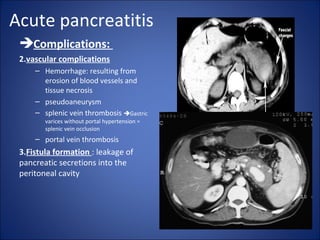 Acute pancreatitis
Complications:
2.vascular complications
– Hemorrhage: resulting from
erosion of blood vessels and
tissue necrosis
– pseudoaneurysm
– splenic vein thrombosis Gastric
varices without portal hypertension =
splenic vein occlusion
– portal vein thrombosis
3.Fistula formation : leakage of
pancreatic secretions into the
peritoneal cavity
 