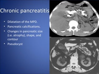 Chronic pancreatitis
• Dilatation of the MPD.
• Pancreatic calcifications.
• Changes in pancreatic size
(i.e. atrophy), shape, and
contour
• Pseudocyst
 