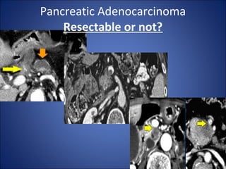 Pancreatic Adenocarcinoma
Resectable or not?
 