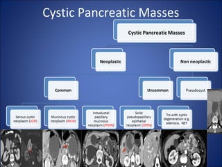 Cystic Pancreatic Masses
 