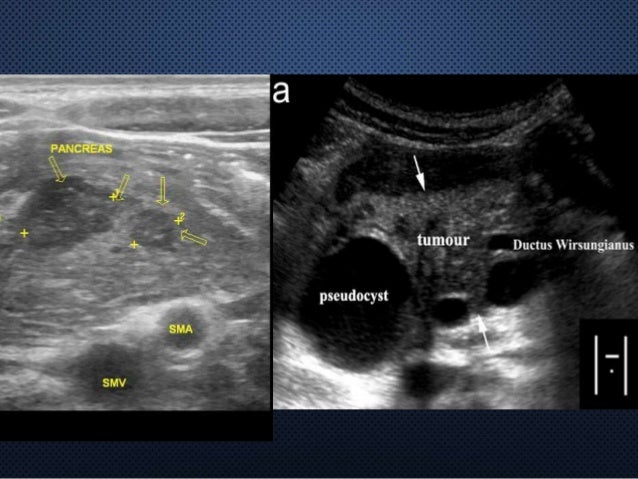 Pancreas