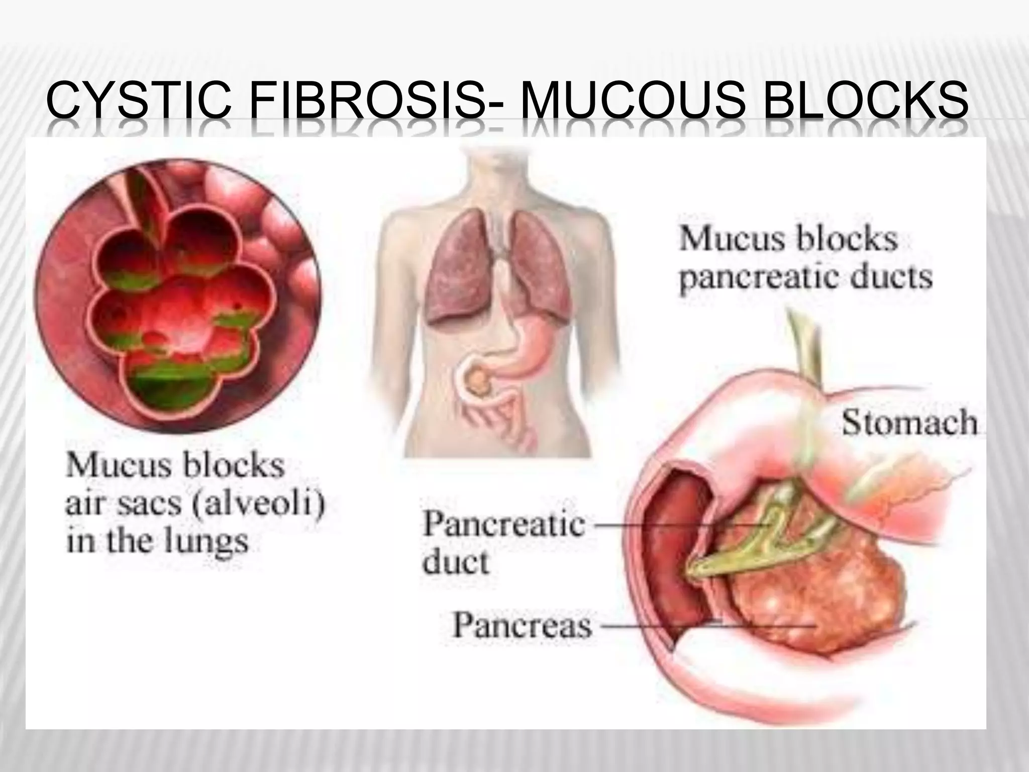 CYSTIC FIBROSIS- MUCOUS BLOCKS
 