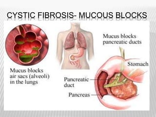CYSTIC FIBROSIS- MUCOUS BLOCKS
 