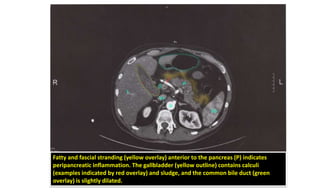 Fatty and fascial stranding (yellow overlay) anterior to the pancreas (P) indicates
peripancreatic inflammation. The gallbladder (yellow outline) contains calculi
(examples indicated by red overlay) and sludge, and the common bile duct (green
overlay) is slightly dilated.
 