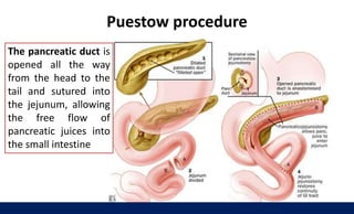 Puestow procedure
The pancreatic duct is
opened all the way
from the head to the
tail and sutured into
the jejunum, allowing
the free flow of
pancreatic juices into
the small intestine
 