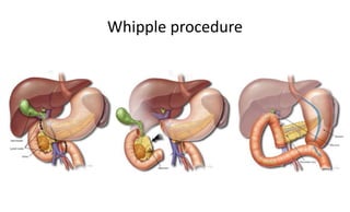 Whipple procedure
 