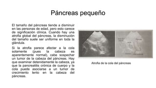 Páncreas pequeño
El tamaño del páncreas tiende a disminuir
en las personas de edad, pero esto carece
de significación clínica. Cuando hay una
atrofia global del páncreas, la disminución
del tamaño suele ser uniforme en toda la
glándula.
Si la atrofia parece afectar a la cola
solamente (pues la cabeza es
aparentemente normal), cabe sospechar
un tumor de la cabeza del páncreas. Hay
que examinar detenidamente la cabeza, ya
que la pancreatitis crónica de cuerpo y la
cola puede asociarse a un tumor de
crecimiento lento en la cabeza del
páncreas.
Atrofia de la cola del páncreas
 