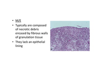 • M/E
• Typically are composed
of necrotic debris
encased by fibrous walls
of granulation tissue
• They lack an epithelial
lining
 