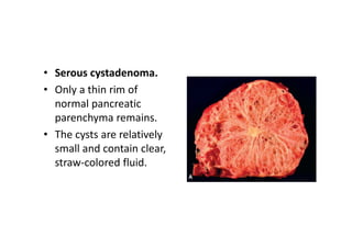 • Serous cystadenoma.
• Only a thin rim of
normal pancreatic
parenchyma remains.
• The cysts are relatively
small and contain clear,
straw-colored fluid.
 