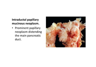 Intraductal papillary
mucinous neoplasm.
• Prominent papillary
neoplasm distending
the main pancreatic
duct.
 