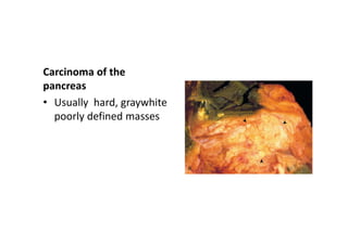 Carcinoma of the
pancreas
• Usually hard, graywhite
poorly defined masses
 