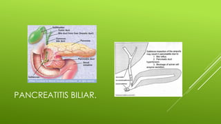 PANCREATITIS BILIAR.
 