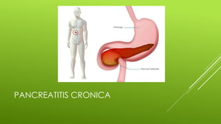 PANCREATITIS CRONICA
 