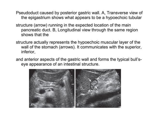 Pancreas ultrasound | PPT | Endocrine and Metabolic Diseases | Diseases ...