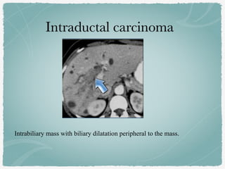 Intrabiliary mass with biliary dilatation peripheral to the mass.
 