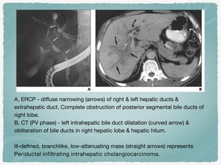 A, ERCP - diffuse narrowing (arrows) of right & left hepatic ducts &
extrahepatic duct. Complete obstruction of posterior segmental bile ducts of
right lobe.
B, CT (PV phase) - left intrahepatic bile duct dilatation (curved arrow) &
obliteration of bile ducts in right hepatic lobe & hepatic hilum.
Ill-defined, branchlike, low-attenuating mass (straight arrows) represents
Periductal infiltrating intrahepatic cholangiocarcinoma.
 