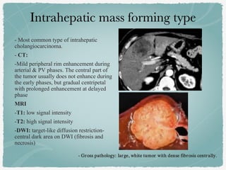 - Most common type of intrahepatic
cholangiocarcinoma.
- CT:
-Mild peripheral rim enhancement during
arterial & PV phases. The central part of
the tumor usually does not enhance during
the early phases, but gradual centripetal
with prolonged enhancement at delayed
phase
MRI
-T1: low signal intensity
-T2: high signal intensity
-DWI: target-like diffusion restriction-
central dark area on DWI (fibrosis and
necrosis)
- Gross pathology: large, white tumor with dense fibrosis centrally.
 
