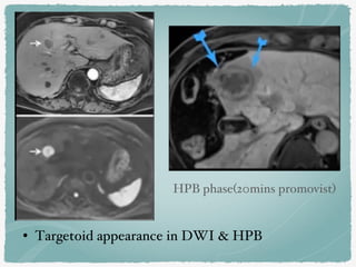 • Targetoid appearance in DWI & HPB
HPB phase(20mins promovist)
 
