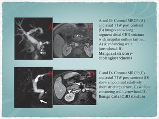 A and B- Coronal MRCP (A)
and axial T1W post contrast
(B) images show long
segment distal CBD stricture
with irregular outline (arrow,
A) & enhancing wall
(arrowhead, B).
Malignant stricture-
cholangiocarcinoma
C and D- Coronal MRCP (C)
and axial T1W post contrast (D)
show smooth and relatively
short stricture (arrow, C) without
enhancing wall (arrowhead,D).
Benign distal CBD stricture
A
B
C
D
 