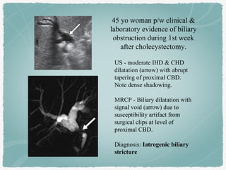US - moderate IHD & CHD
dilatation (arrow) with abrupt
tapering of proximal CBD.
Note dense shadowing.
MRCP - Biliary dilatation with
signal void (arrow) due to
susceptibility artifact from
surgical clips at level of
proximal CBD.
Diagnosis: Iatrogenic biliary
stricture
45 yo woman p/w clinical &
laboratory evidence of biliary
obstruction during 1st week
after cholecystectomy.
 