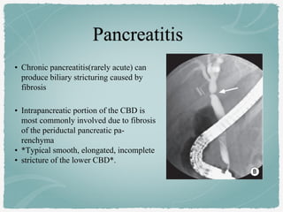 • Chronic pancreatitis(rarely acute) can
produce biliary stricturing caused by
fibrosis
• Intrapancreatic portion of the CBD is
most commonly involved due to fibrosis
of the periductal pancreatic pa-
renchyma
• *Typical smooth, elongated, incomplete
• stricture of the lower CBD*.
 