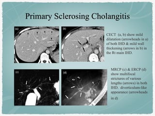 CECT (a, b) show mild
dilatation (arrowheads in a)
of both IHD & mild wall
thickening (arrows in b) in
the Rt main IHD.
MRCP (c) & ERCP (d)
show multifocal
strictures of various
lengths (arrows) in both
IHD. diverticulum-like
appearance (arrowheads
in d)
 