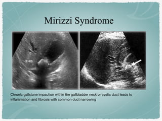 Chronic gallstone impaction within the gallbladder neck or cystic duct leads to
inflammation and fibrosis with common duct narrowing
 