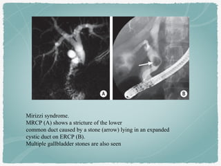 Mirizzi syndrome.
MRCP (A) shows a stricture of the lower
common duct caused by a stone (arrow) lying in an expanded
cystic duct on ERCP (B).
Multiple gallbladder stones are also seen
 