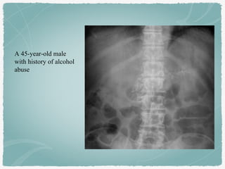 A 45-year-old male
with history of alcohol
abuse
 