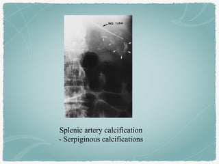 Splenic artery calcification
- Serpiginous calcifications
 