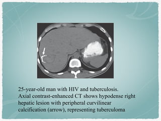 25-year-old man with HIV and tuberculosis.
Axial contrast-enhanced CT shows hypodense right
hepatic lesion with peripheral curvilinear
calcification (arrow), representing tuberculoma
 