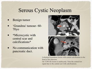 • Benign tumor 
• ‘Grandma' tumour- 60-
70yo
• *Microcystic with
central scar and
calcifications*
• No communication with
pancreatic duct.
Lobulated hypodense lesion with central calcification in the
head of the pancreas.
On T2WI the lesion is multicystic. Note the central low
signal due to the central scar with calcifications.
 