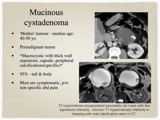 • 'Mother' tumour - median age:
40-50 yo
• Premalignant tumor
• *Macrocystic with thick wall
septations, capsule, peripheral
calcifications(specific)*
• 95% - tail & body
• Most are symptomatic, p/w
non specific abd pain
T2 hyperintense encapsulated pancreatic tail mass with few
septations inferiorly. intrinsic T1 hyperintensity inferiorly in
keeping with wall calcification seen in CT.
 
