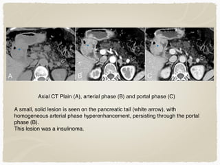 Axial CT Plain (A), arterial phase (B) and portal phase (C)
A small, solid lesion is seen on the pancreatic tail (white arrow), with
homogeneous arterial phase hyperenhancement, persisting through the portal
phase (B).
This lesion was a insulinoma.
 