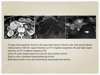 A larger heterogeneous lesion in the pancreatic head is shown, also with arterial phase
enhancement, with low signal intensity on T1-weighted sequences (E) and high signal
intensity on T2-weighted sequences (F).
Areas of cystic degeneration can also be seen (yellow arrow).
There is also a duodenal hyperenhancing lesion.
Both these lesions were non-functioning neuroendocrine tumors.
 