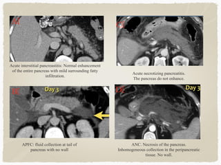 A)
B)
C)
D)
Acute interstitial pancreastitis: Normal enhancement
of the entire pancreas with mild surrounding fatty
infiltration.
ANC. Necrosis of the pancreas.
Inhomogeneous collection in the peripancreatic
tissue. No wall.
Acute necrotizing pancreatitis.
The pancreas do not enhance.
APFC: fluid collection at tail of
pancreas with no wall
 