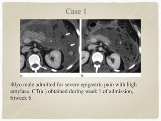 40yo male admitted for severe epigastric pain with high
amylase. CT(a.) obtained during week 1 of admission,
b)week 6.
 