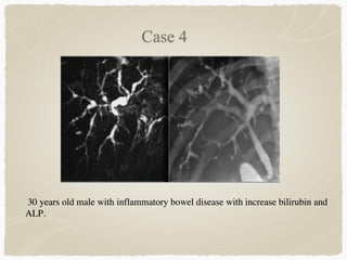 30 years old male with inflammatory bowel disease with increase bilirubin and
ALP.
 