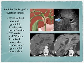 • US: ill defined
mass with
right & left
Intrahepatic
duct dilatation
• CT arterial
and PV phase
Ill defined
mass at the
confluence of
right and left
hepatic duct
 