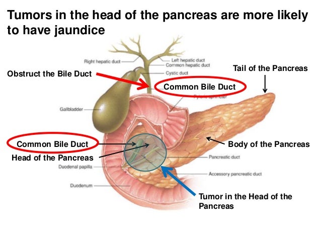 Tumor neuroendocrino páncreas esperanza de vida